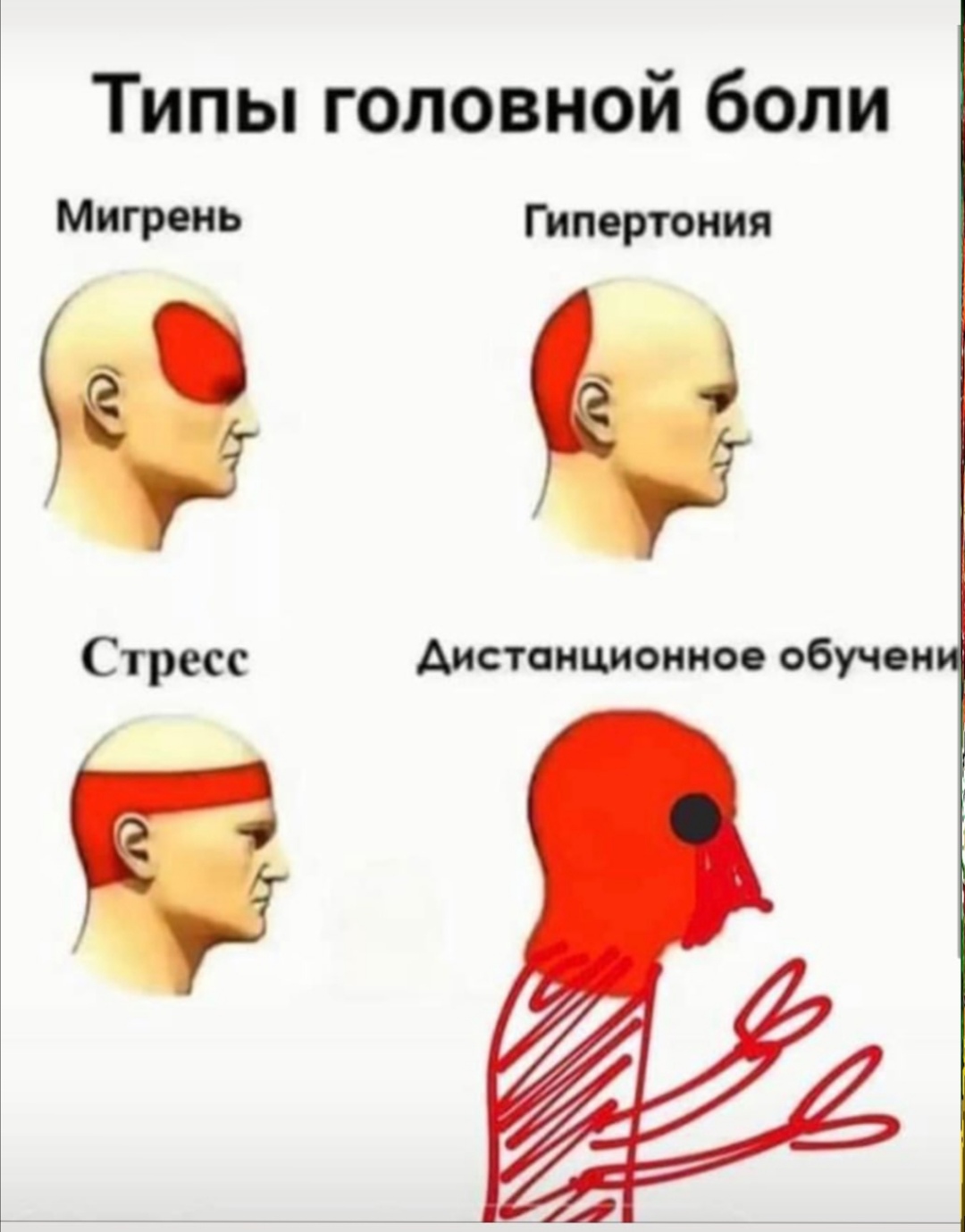 Типы головной боли